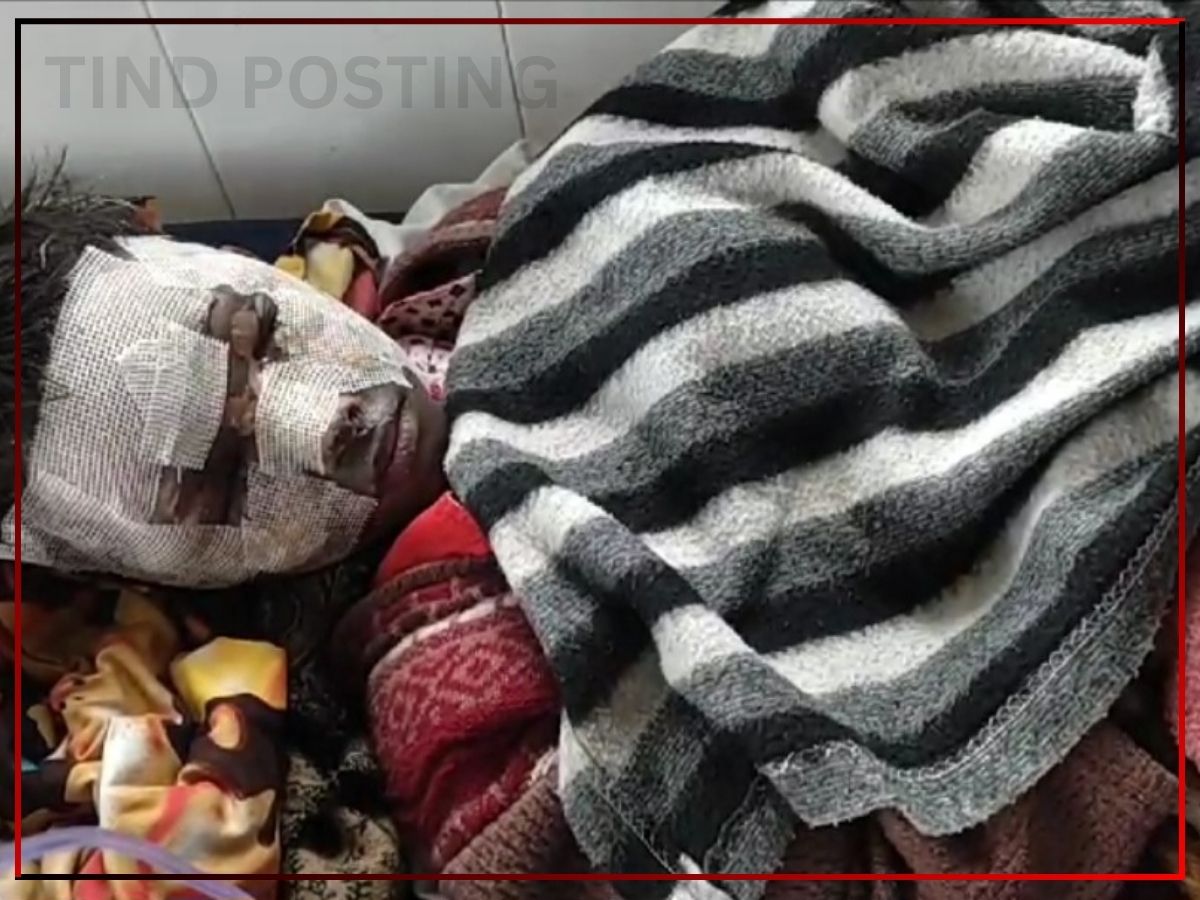 Jamshedpur News: 8-Year-Old Aryan from Sakchi Burned his face while playing with Firecrackers