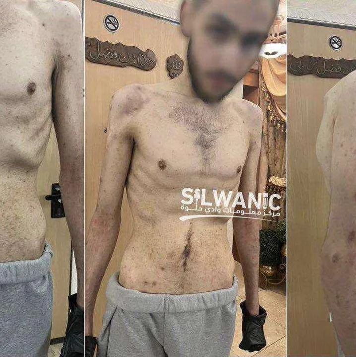 Palestinian Prisoners Show Signs of Torture, Malnutrition After Israel Release